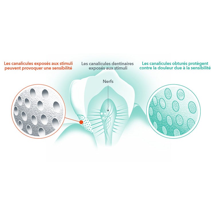 Pourquoi les dents sont-elles sensibles ?