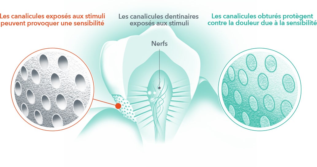 Pourquoi les dents sont-elles sensibles ?
